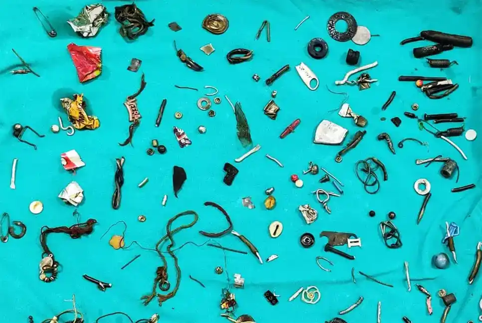 Surgery Reveals 100 Items in Patient's Stomach My News Bangladesh
